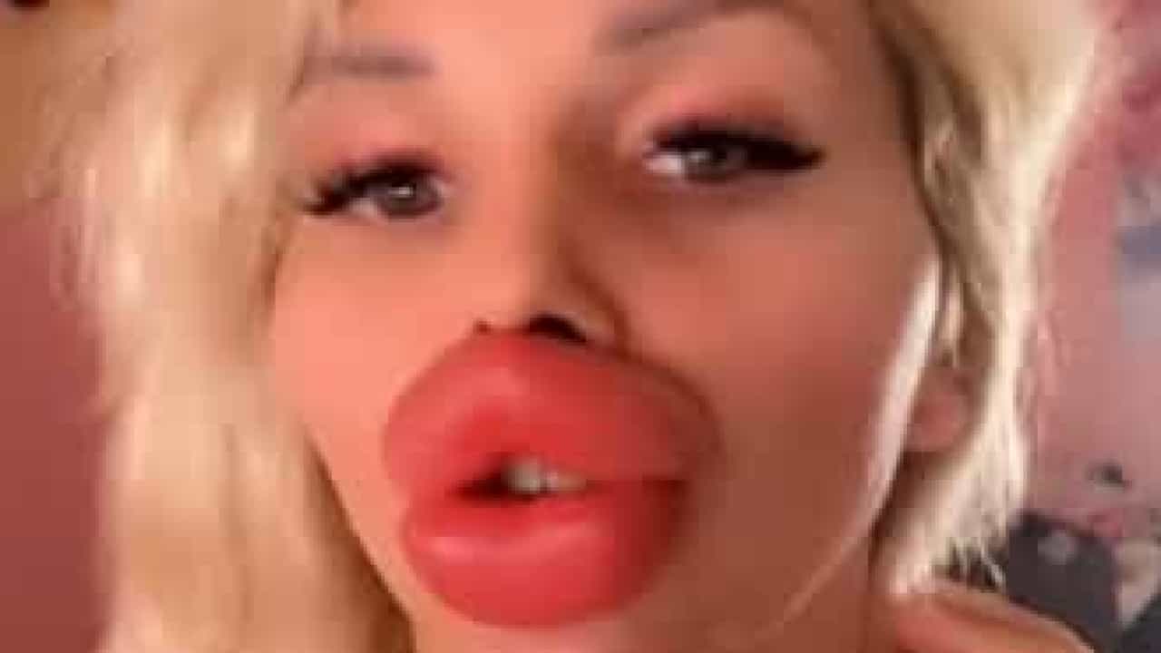 España.  Mujer con labios enormes dice que no puede comer ni beber bien